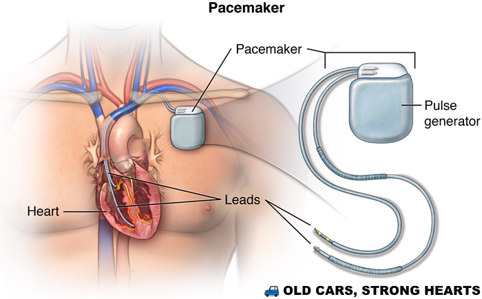 Кардиостимулятор сердца что это такое фото